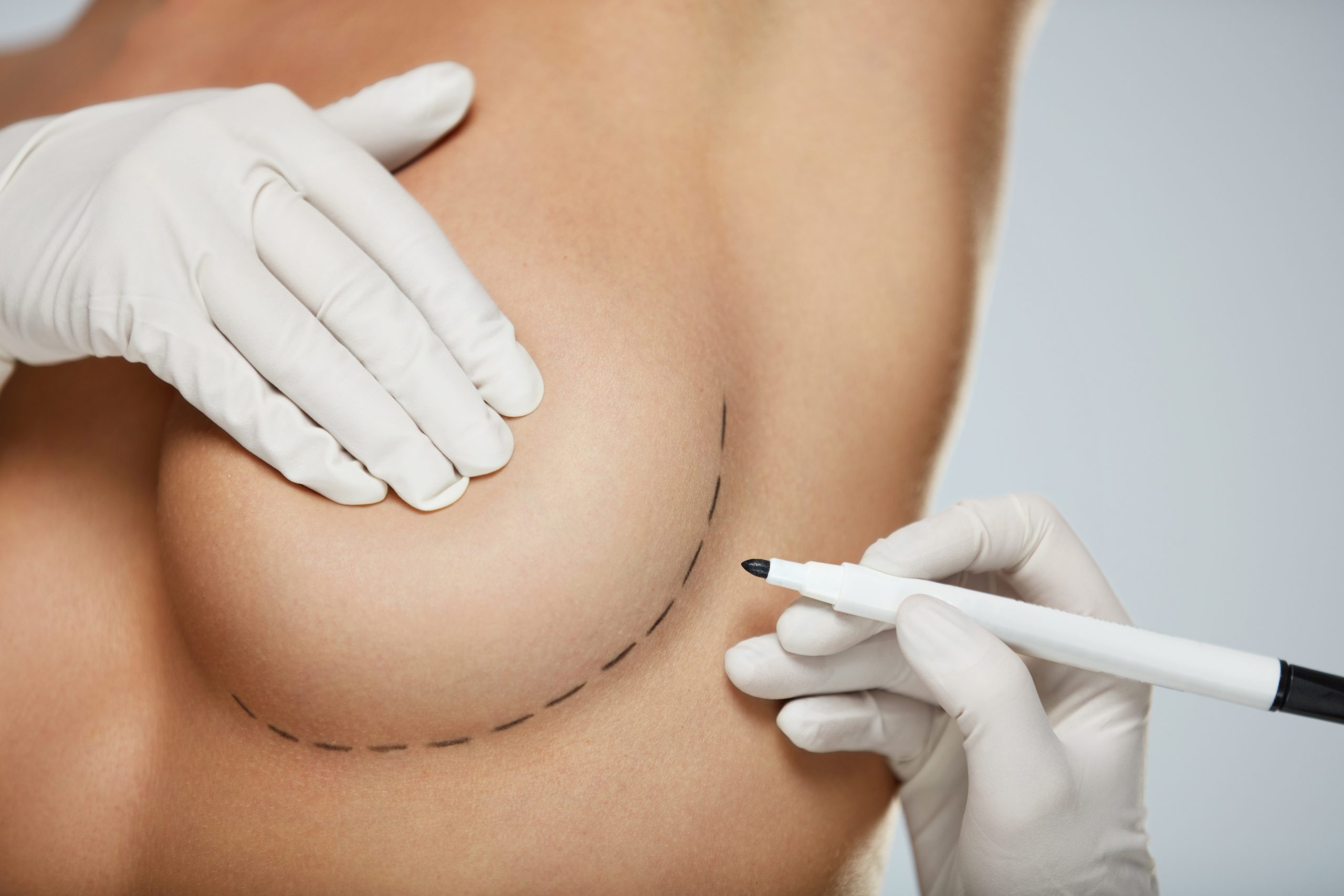 bellecour esthetique lifting mammaire cure ptose